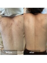 モカ 天王寺店(MOKA)/剥離 背中 5回目