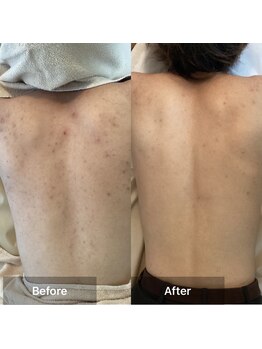 モカ 天王寺店(MOKA)/剥離 背中 5回目