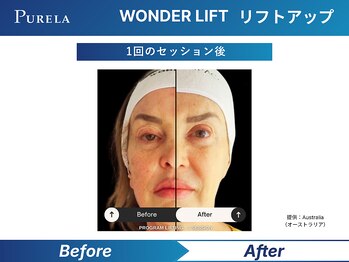 ピュアラ グランピュアラ西梅田店/最新小顔リフト