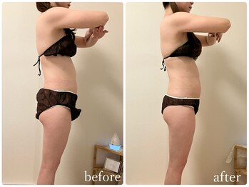 リリィブラン(Lily branc)/ブライダル痩身/背中+二の腕+肩