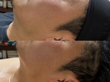 エステサロン ジョアアンジェ(joie ange)/レッドショット1回導入のみ！