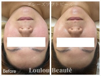 ルルボーテ(Loulou Beaute)/グレーズソフトピール