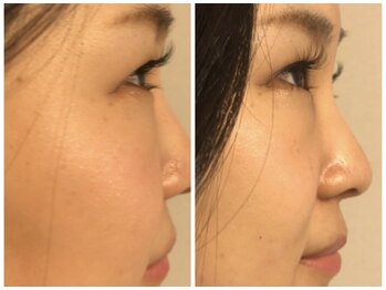 長寿鍼灸院 長寿整骨院/ハリネズミ女優美容鍼効果★