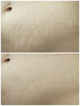 ルミア(LUMIA)/妊娠線や肉割れを改善