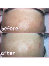 プラスボーテ 幡ヶ谷(plus beaute)/毛穴の黒ずみ、古い角質除去に☆