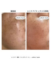 エステティック ハンズ(esthetic hands)/【お客様症例・経過】50代女性