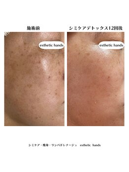 エステティック ハンズ(esthetic hands)/【お客様症例・経過】50代女性