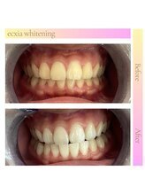 エクシアホワイトニング 西宮北口店/ホワイトニングビフォーアフター