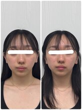 ラフテル鍼灸整骨院/小顔矯正×美容鍼でむくみ改善