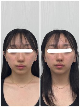 ラフテル鍼灸整骨院/小顔矯正×美容鍼でむくみ改善