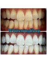 ホワイトニングショップ 高松瓦町店/Before&After美白ホワイトニング