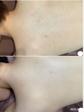 フルール(Fleur)/■背中トリートメント■