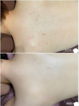 フルール(Fleur)/■背中トリートメント■