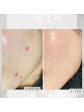 ミスティビオ 平尾店(mistyBIO)/《ニキビケア》