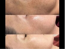 アナパ・オラ/ハーブトリートメント（2.5g）