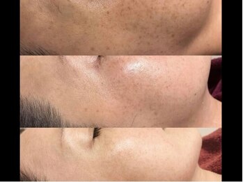 アナパ・オラ/ハーブトリートメント（2.5g）