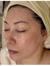 ラシェプリズ(LACHER PRISE)/施術経過（40代）