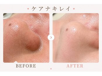 パールプラス 大田原店(Pearl plus)/毛穴汚れが浮き出る!!