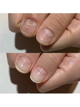 アティックネイルアトリエ(attic nail atelier)/トラブル爪改善コース