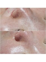 クリード(CLEAD)/毛穴洗浄☆ハイドラフェイシャル