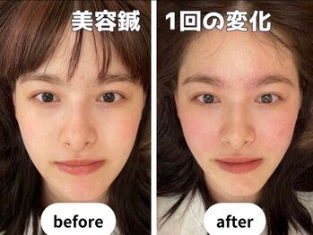 恵比寿すこやか鍼灸整骨院/1度の施術だけでも小顔効果