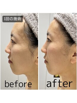 きれい塾 恵比寿/低周波リフト