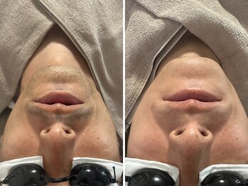 ヌー(gnu)/結果重視！メンズ美肌ヒゲ脱毛