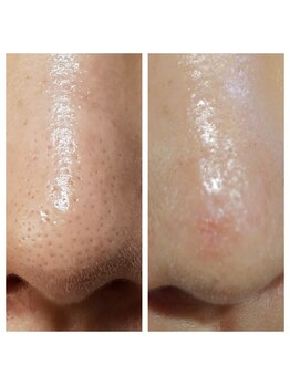 ビーシェイプ 君津(B-Shape)/症例【毛穴洗浄/ZEROピール】