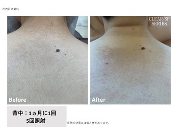 ラレピア(LA LEPIA)/お客様BeforeAfter☆