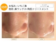 ムーンサン(Moon sun)/20代お鼻ケア、お任せください