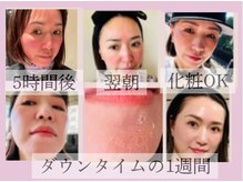 オーダーメイド無農薬ハーブピーリング☆お肌の土台を育てます♪