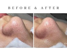 ルシェリア(Le cherien)/ハイドラ×ピーリング