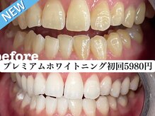 ホワイト 福岡博多店(WHITE)/初回プレミアムホワイトニング
