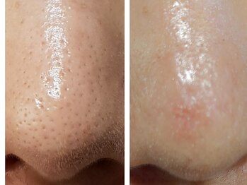 シミ・毛穴改善&美白フェイシャルサロン/毛穴も引き締まるララピール