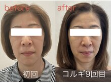 ビーキュート 姫路店(BE-CUTE)/小顔コルギ9回目