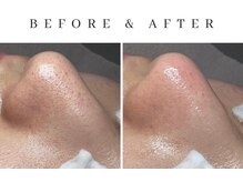 ルシェリア(Le cherien)/ハイドラ×ピーリング