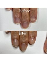 マニュコクーン(ManuCocoon)/爪育成　深爪　巻き爪　大阪市