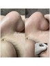 【毛穴エクストラクション】洗浄剤使用なし特殊技術☆敏感肌OKダウンタイム0