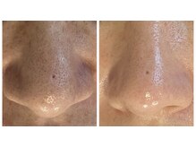 グランツ(Glanz)の雰囲気（毛穴のbefore⇒after）
