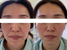 サクラ 本厚木駅前店(SAKURA)/【本厚木/シミケア/たるみケア】