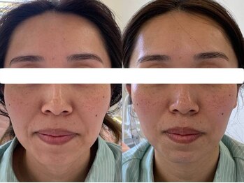 サクラ 本厚木駅前店(SAKURA)/【本厚木/シミケア/たるみケア】