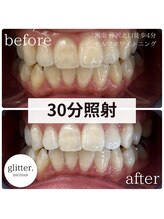 グリッター ショウナン(glitter. SHONAN)/30分での効果!!歯は白い時代へ