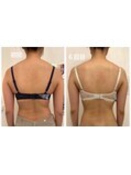 美人バスト 表参道店/バストアップ症例/育乳6回コース