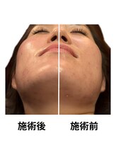 はりまや 方南町/左のみ施術したお写真です★