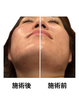 はりまや 方南町/左のみ施術したお写真です★