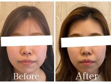 サロンベイビー 西宮本店(Salon Baby)/【BeforeAfter】小顔美容整顔