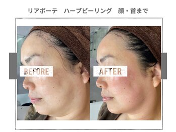 ラ ルーチェ 星田/幹細胞ハーブピーリング