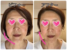 ソラ アロマ ナチュラ(sora aroma natura)/【大人気】小顔フェイシャル