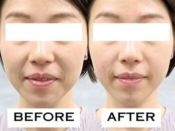 ビハリスト 麻布十番/ほうれい線が改善!