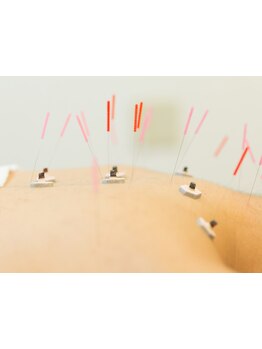 鍼灸施術を受けたい